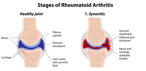 What Is Rheumatoid Arthritis University Of Birmingham