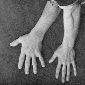 Comparison between a hand enlarged due to a pituitary gland disease and an adjacent healthy hand