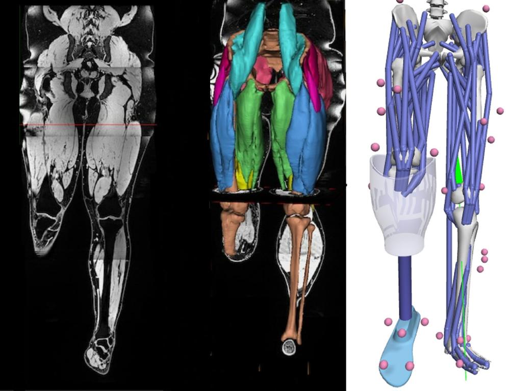 Hip muscle exercises could help amputees improve functional mobility ...