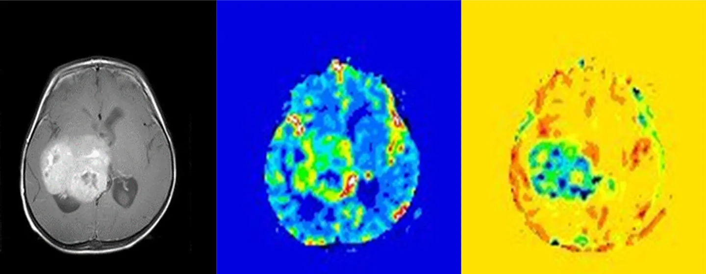 Conventional MRI scan of a tumour on the left. MRI with a contrast agent shows a high blood volume in the centre image. After correction, the image on the right shows a high level of leakiness, which this study demonstrated is a feature associated with aggressive tumours.