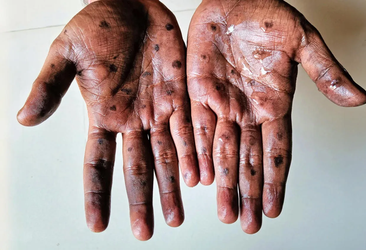 Sores on the hands of a person infected with mpox